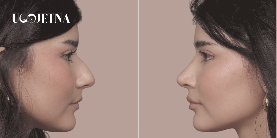 Rinoplastika prije operacije i što je sve važno znati