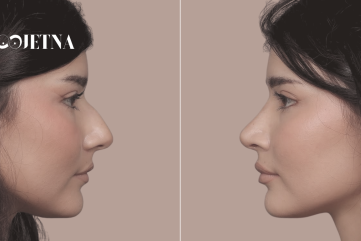 Rinoplastika prije operacije i što je sve važno znati