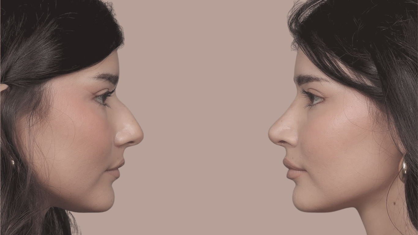 rinoplastika