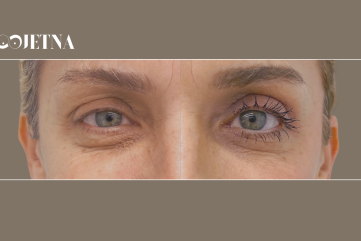 Blefaroplastika prije operacije: Što je važno znati prije zahvata na kapcima