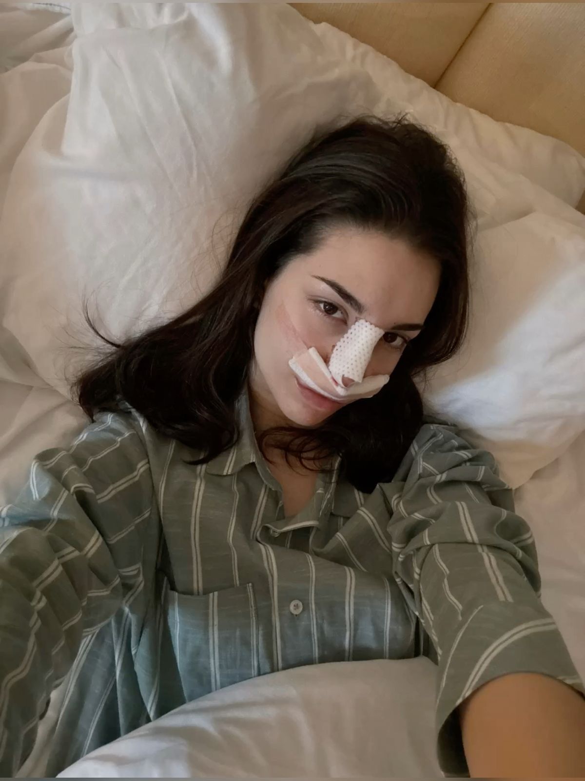 oporavak-rinoplastika