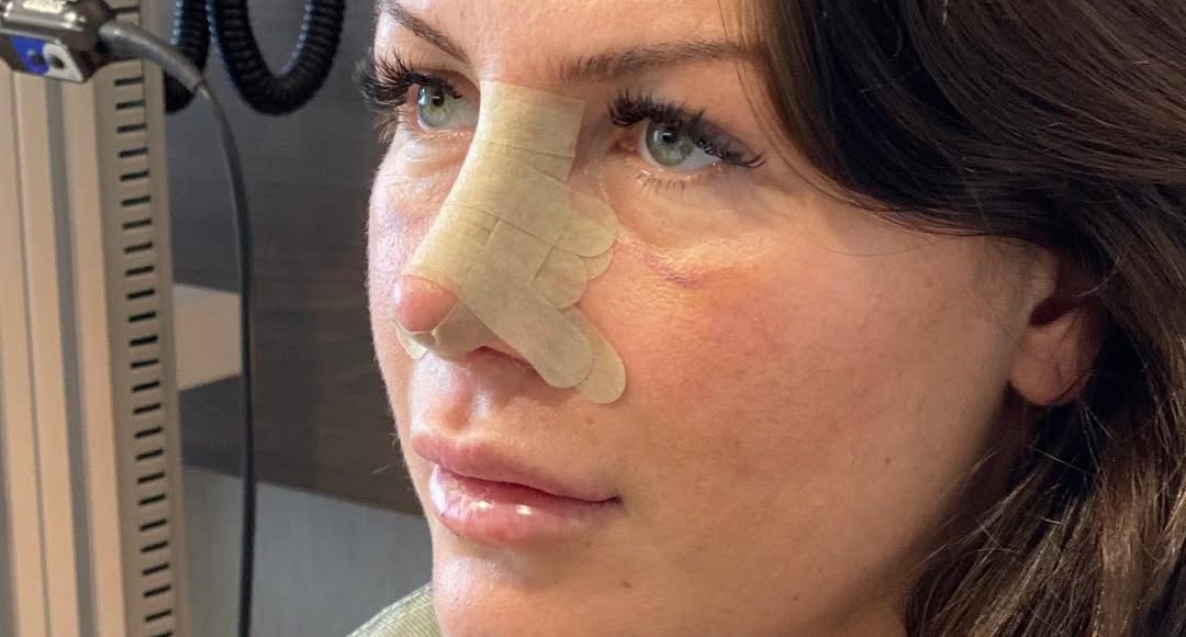 rinoplastika-oporavak