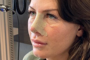 rinoplastika-oporavak