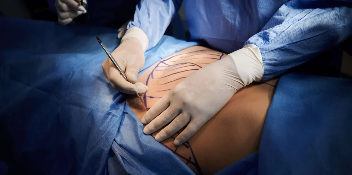 abdominoplatika