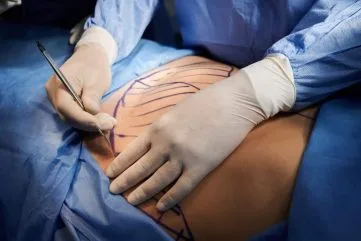 abdominoplatika
