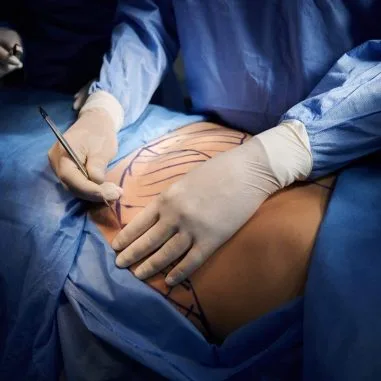 abdominoplatika