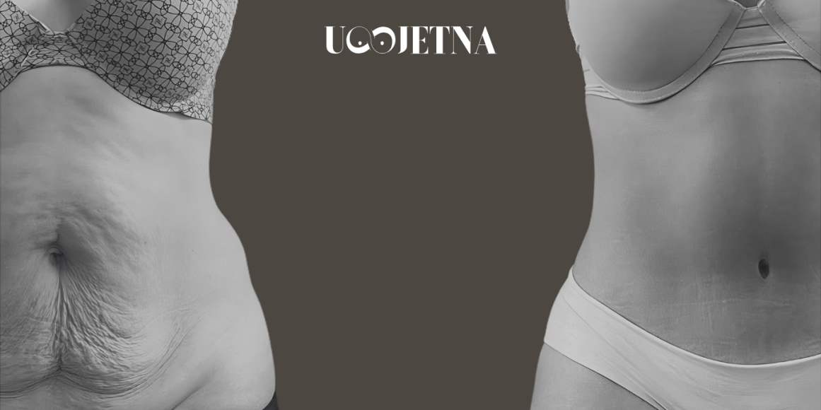 abdominoplastika