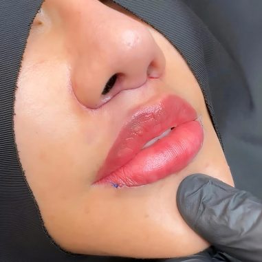 lip-lift-tanke-usne