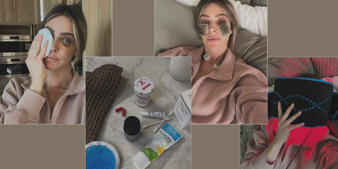 blefaroplastika oporavak