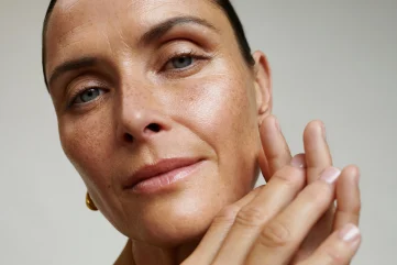 melasma