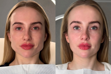 masseter-botox