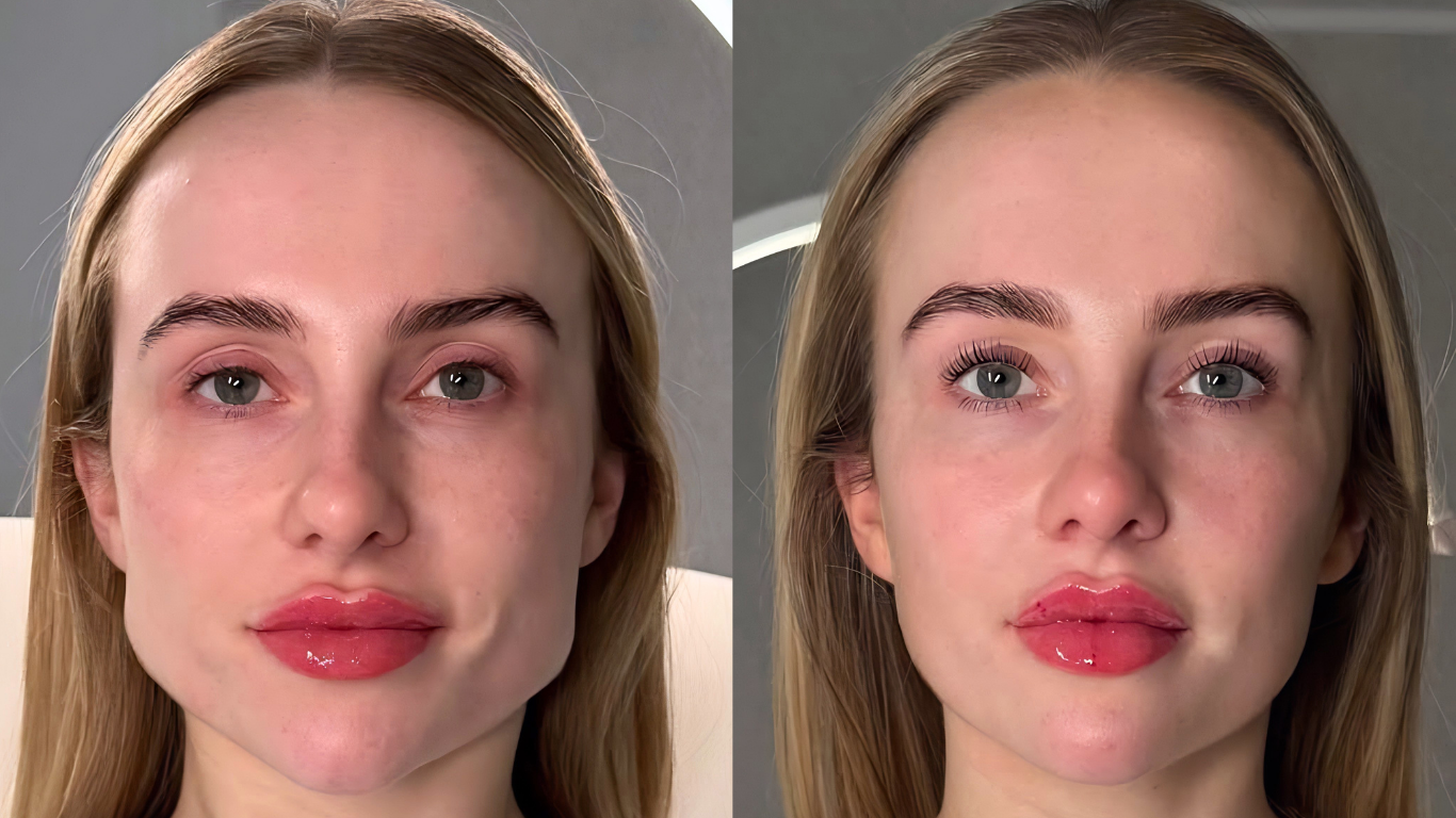masseter-botox