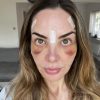 blefaroplastika-oporavak