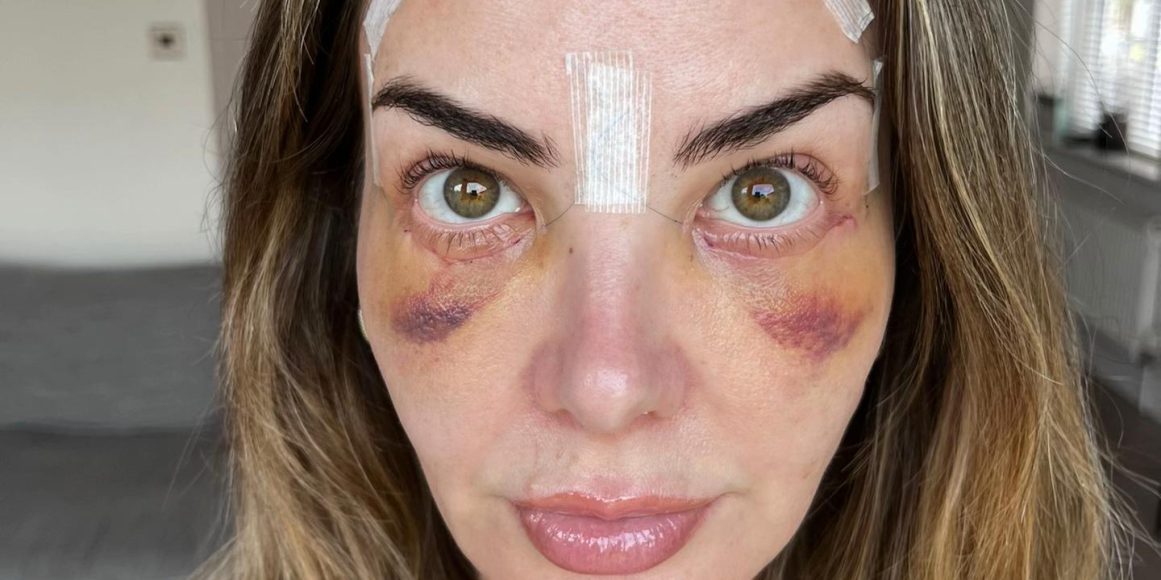 blefaroplastika-oporavak