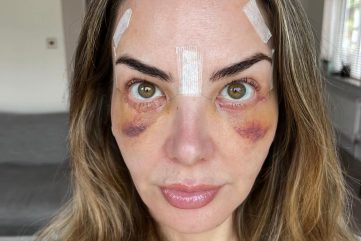 blefaroplastika-oporavak