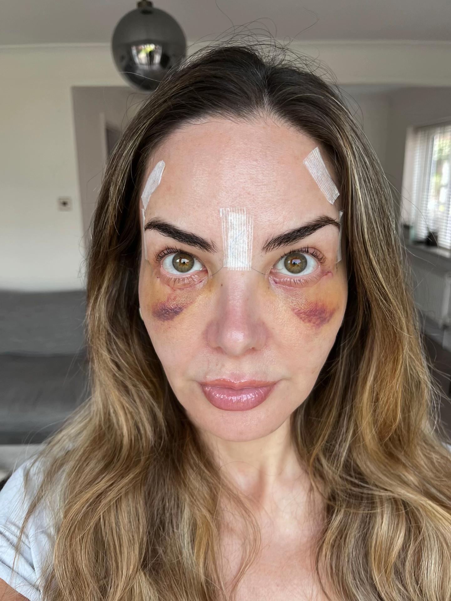 blefaroplastika-oporavak