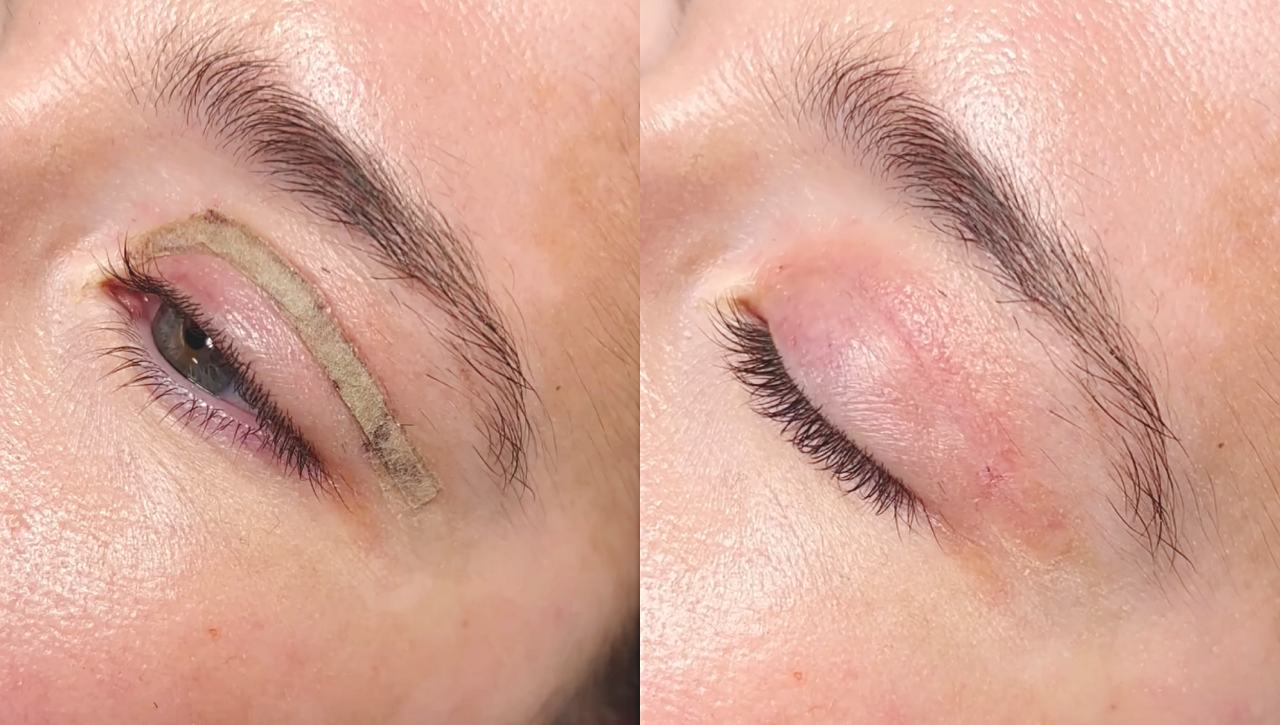ožiljci-blefaroplastika