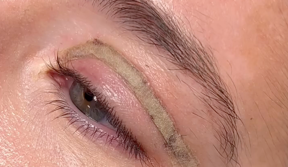 ožiljci-blefaroplastika