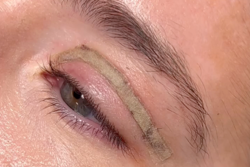 ožiljci-blefaroplastika
