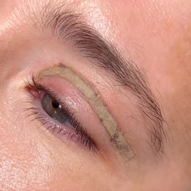 ožiljci-blefaroplastika