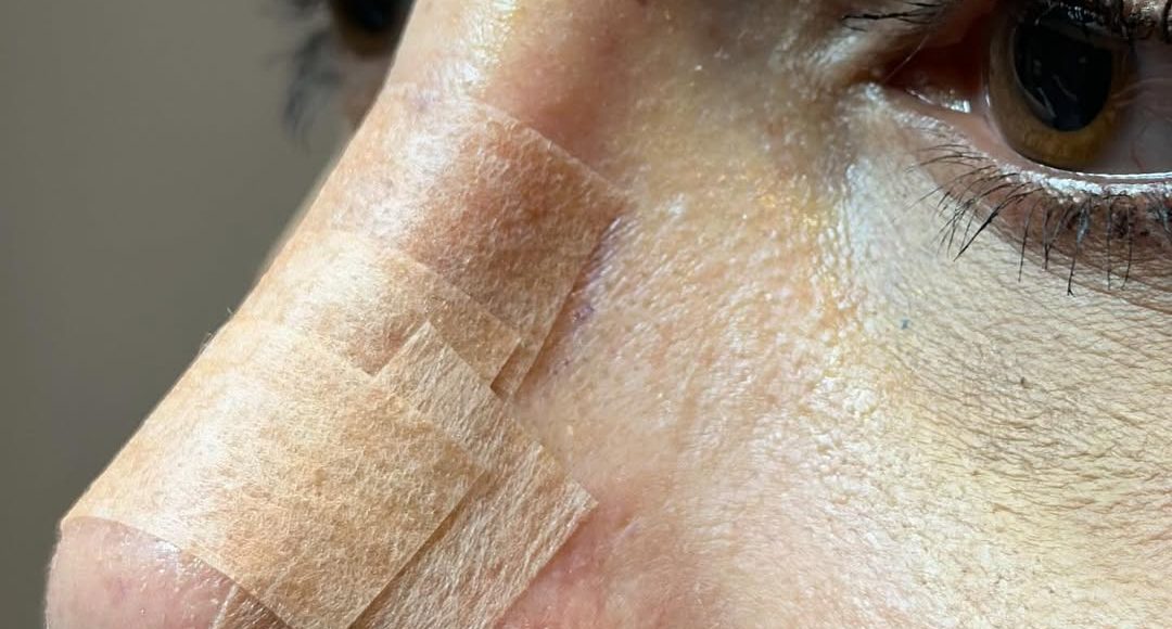 rinoplastika-vrh nosa