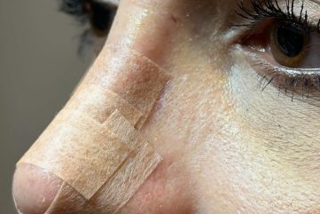 rinoplastika-vrh nosa