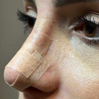 rinoplastika-vrh nosa